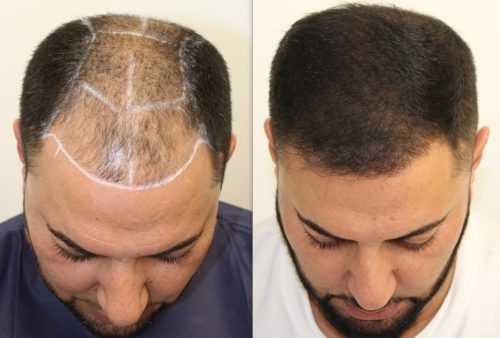 antes y despues del tratamiento de injerto capilar en dr jones