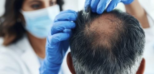 alopecia en pacientes diagnostico