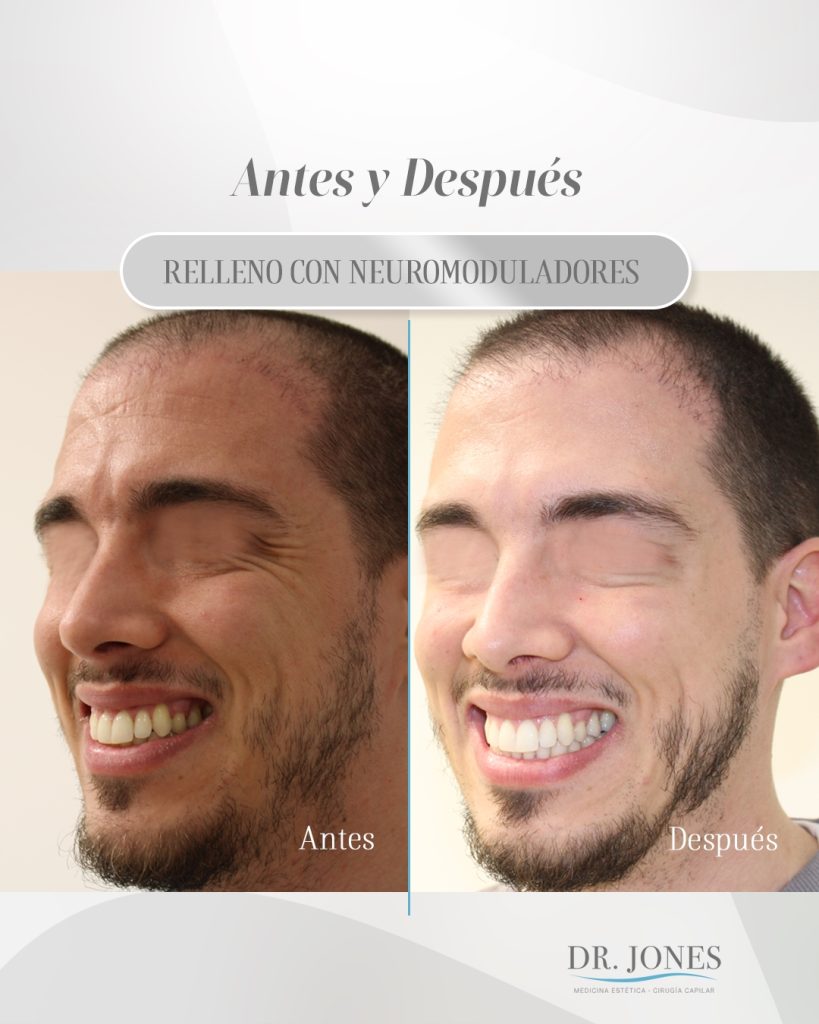 DR JONES antes y despues relleno con neuromoduladores