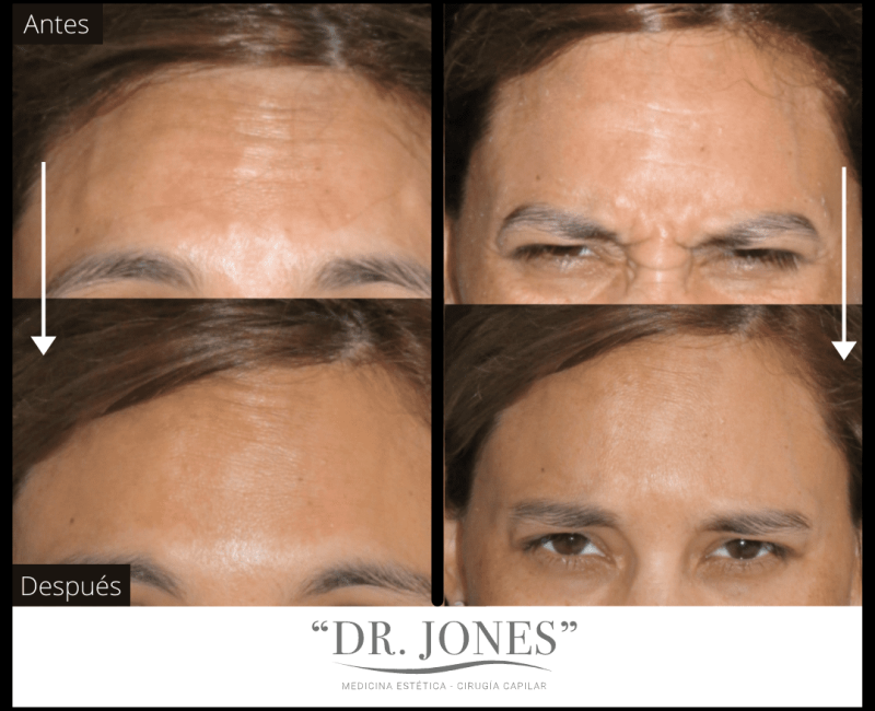 DR JONES - Botox 5 (1)