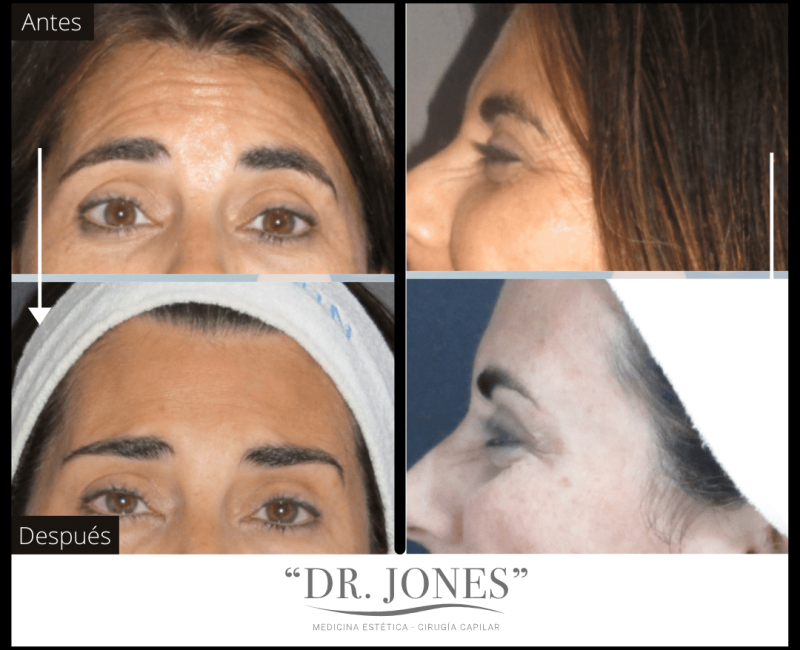 DR JONES - Botox 5 (2)