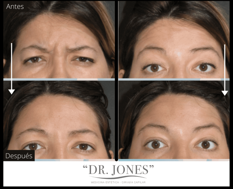 DR JONES - Botox 5 (4)