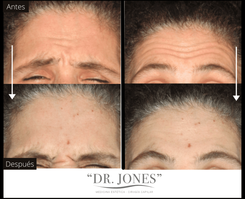 DR JONES - Botox 5