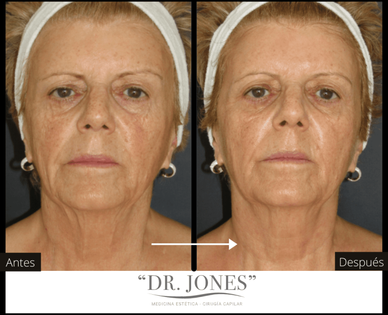DR JONES - Prp facial (1)